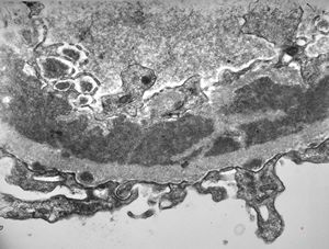 M,37y. | type I membranoproliferative glomerulonephritis (mesangiocapillary) M,37y. | type I membranoproliferative glomerulonephritis (mesangiocapillary)